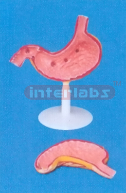 BIG DISEASED ANATOMICAL MAGNIFIED STOMACH MODEL